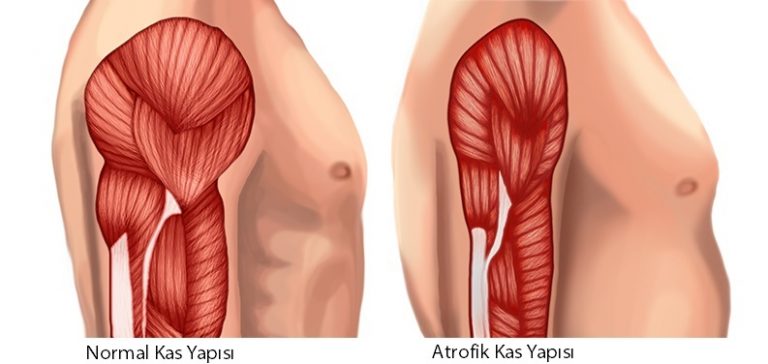 kas-kaybi-atrofi-nedir-768x364.jpg